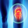 The Value of Joint Replacement for Patients with Osteoarthritis