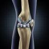 The Value of Joint Replacement in Treating Patients with Osteoarthritis